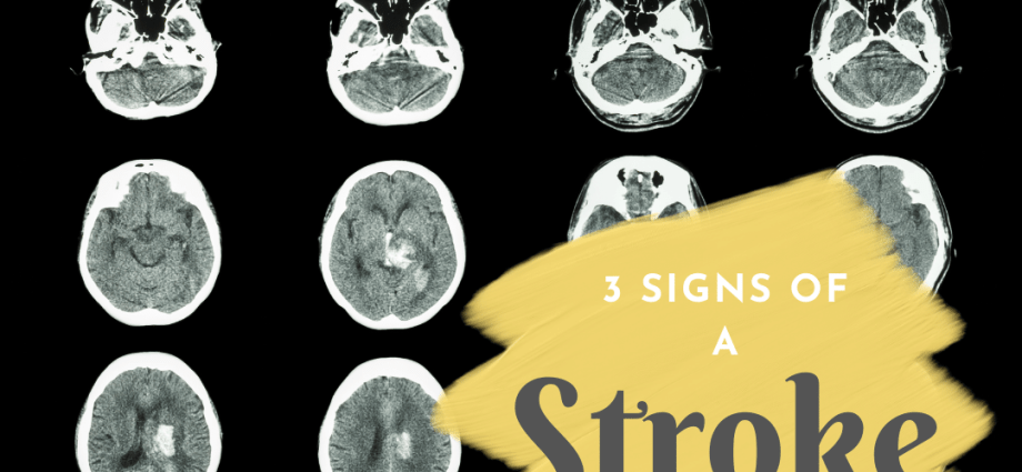 Three symptoms of stroke you can&#8217;t ignore