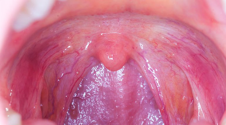 Throat and tongue cancer is getting more frequent. Cause? Oral Sex and HPV