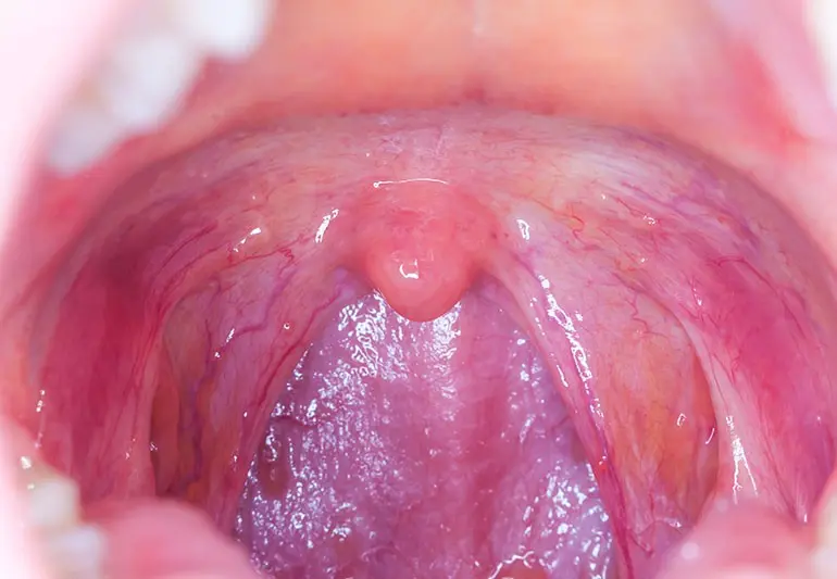 Throat and tongue cancer is getting more frequent. Cause? Oral Sex and HPV