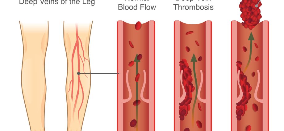 Thrombosis &#8211; a silent killer who attacks unexpectedly