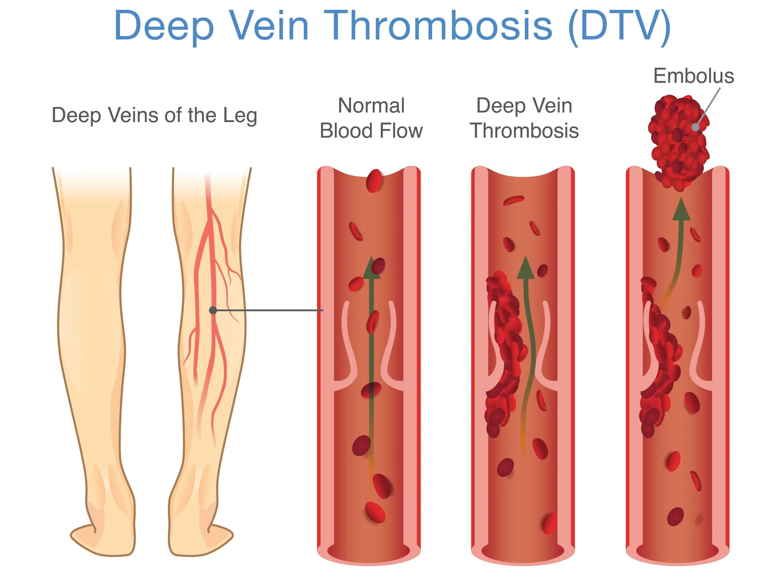 Thrombosis &#8211; a silent killer who attacks unexpectedly