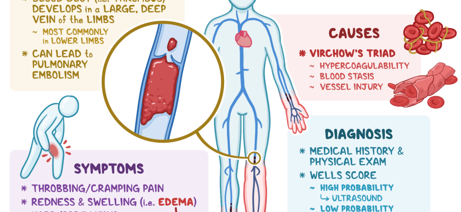 Thrombosis &#8211; causes, treatment and prevention. The six most common symptoms of thrombosis [EXPLAIN]