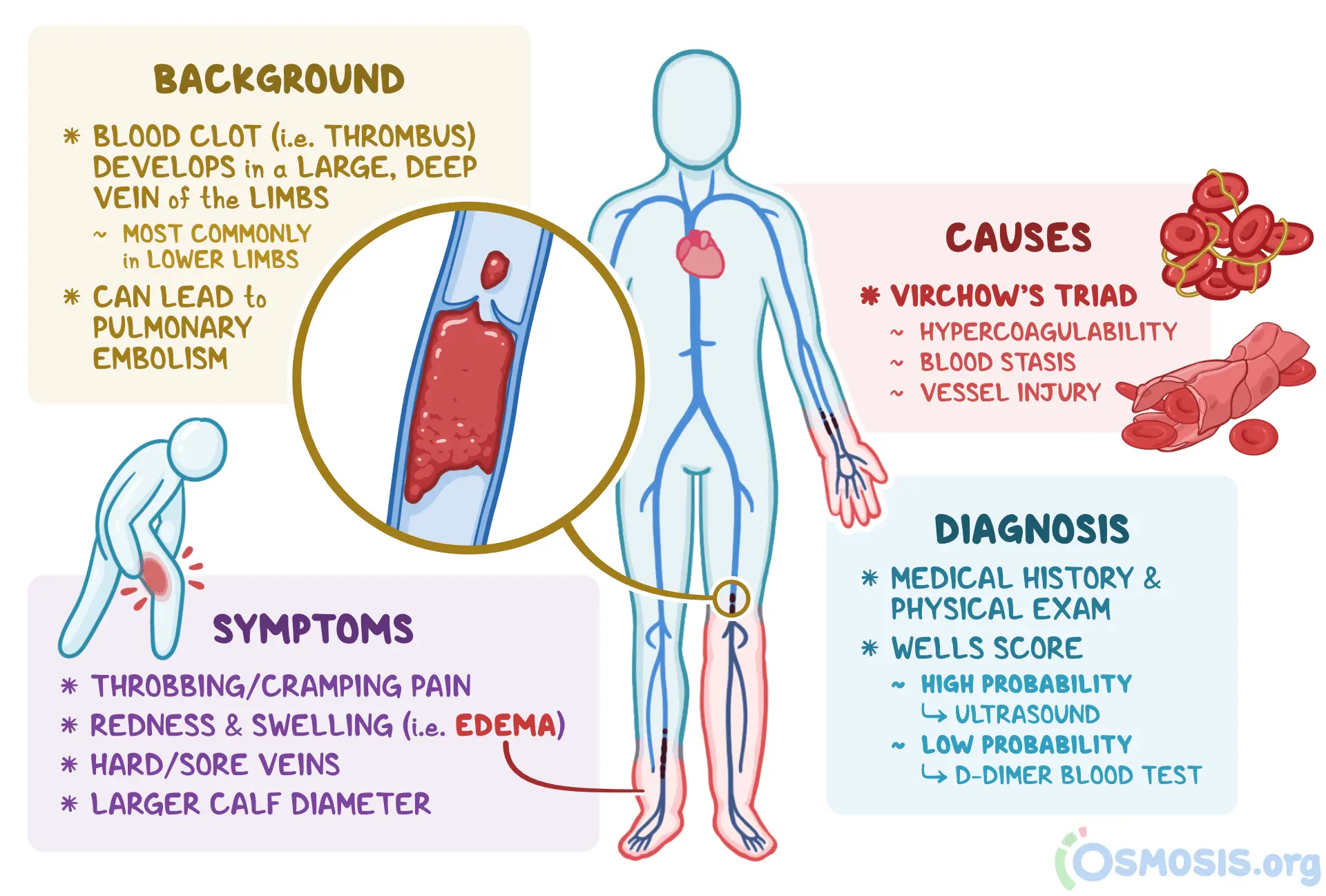 Thrombosis &#8211; causes, treatment and prevention. The six most common symptoms of thrombosis [EXPLAIN]