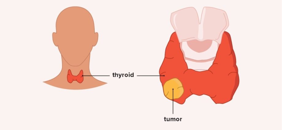 Thyroid neoplasms &#8211; types, causes, symptoms, diagnosis. Treatment of thyroid cancer