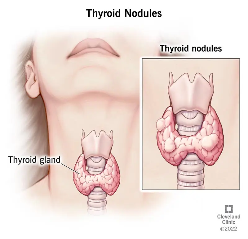 Thyroid nodules &#8211; causes, symptoms, treatment methods. Thyroid nodules and cancer