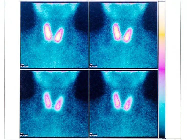 Thyroid scintigraphy &#8211; what does the examination look like?