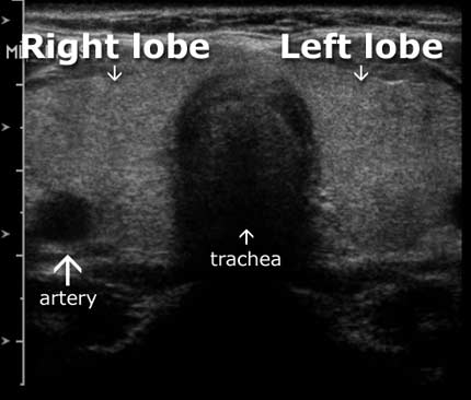 Thyroid ultrasound &#8211; how to interpret the results?