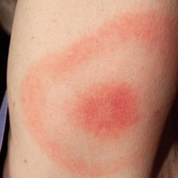 Tick-borne Lyme borreliosis