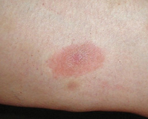 Tick-borne Lyme borreliosis