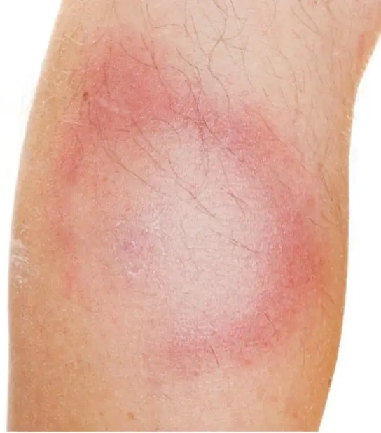 Tick-borne Lyme borreliosis