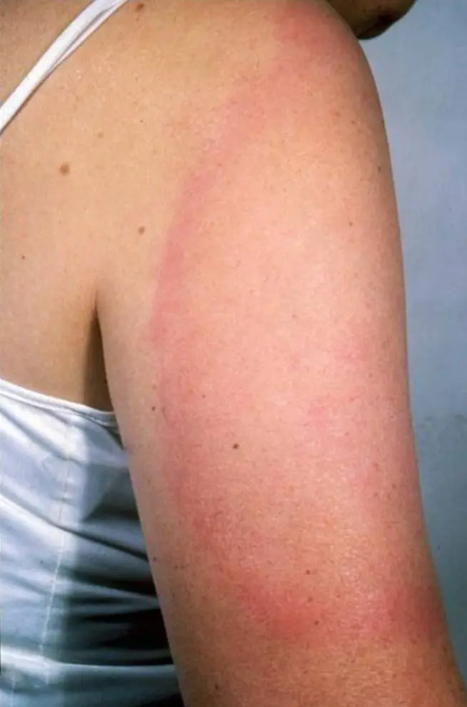 Tick-borne Lyme borreliosis