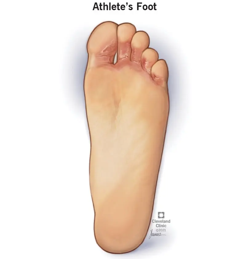 Time for health: Athlete&#8217;s foot