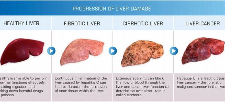 Time for health: Liver cancer