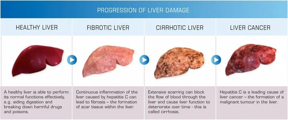 Time for health: Liver cancer