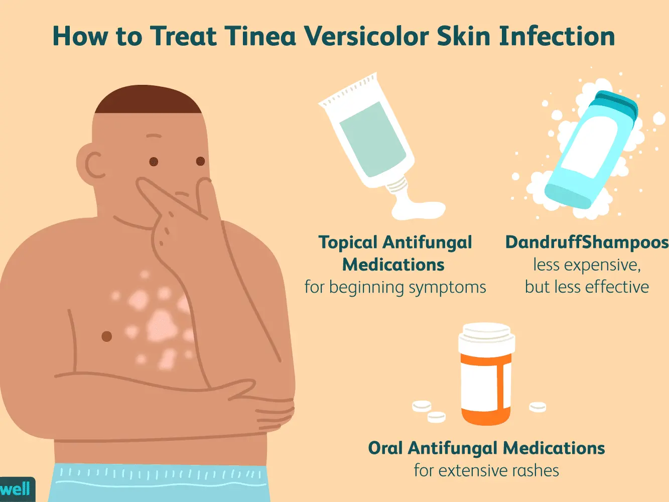 Tinea versicolor &#8211; causes, symptoms, treatment. Home remedies for tinea versicolor