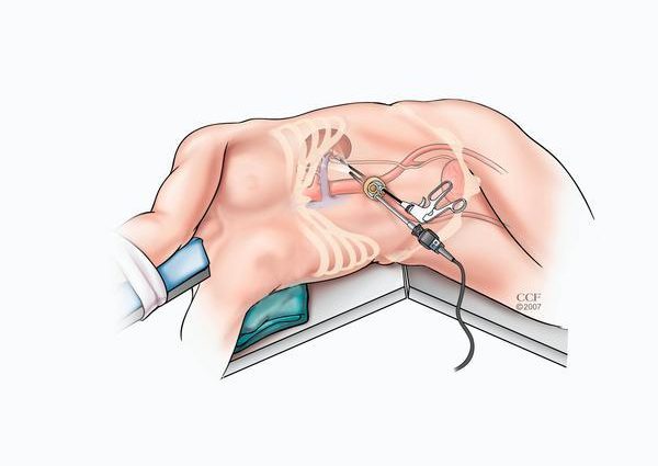 To the kidney through the navel