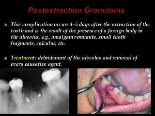 Tooth extraction &#8211; indications, course of the procedure, possible complications