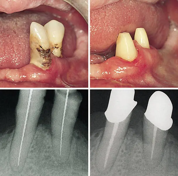 Tooth gangrene &#8211; causes, symptoms, treatment, consequences