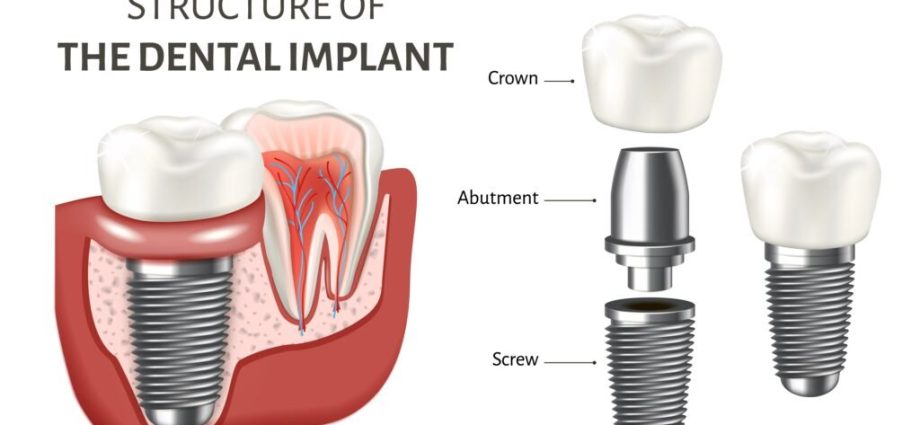 Tooth implants &#8211; techniques and advantages of implantology. How much do dental implants cost?