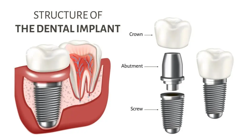 Tooth implants &#8211; techniques and advantages of implantology. How much do dental implants cost?