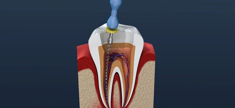 Avvelenamento dei denti: cos'è la devitalizzazione dei denti? È pericoloso? [SPIEGIAMO]