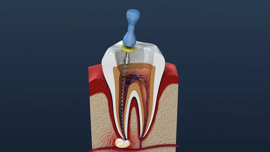 Tooth poisoning &#8211; what is tooth devitalization? Is it dangerous? [WE EXPLAIN]