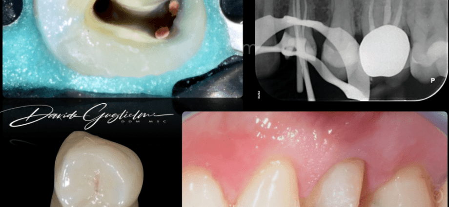 Tooth reconstruction &#8211; composite, root canal treatment, fiberglass. How much does tooth reconstruction cost?