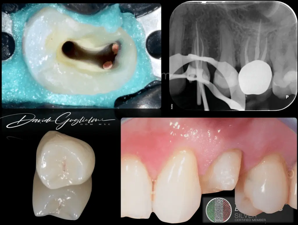 Tooth reconstruction &#8211; composite, root canal treatment, fiberglass. How much does tooth reconstruction cost?