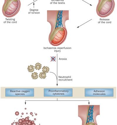 Torsion of the testicle stalk &#8211; causes, symptoms, treatment, surgery