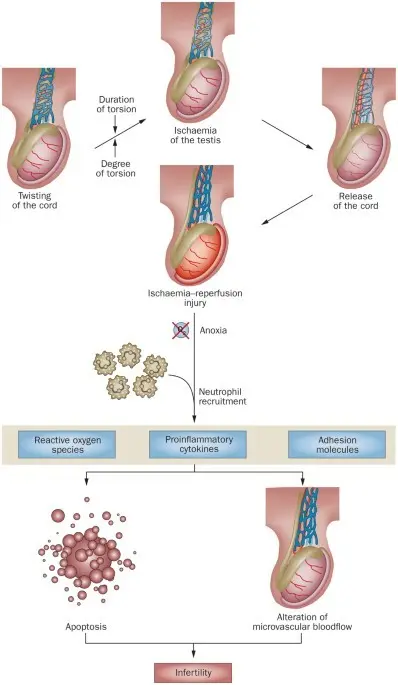 Torsion of the testicle stalk &#8211; causes, symptoms, treatment, surgery