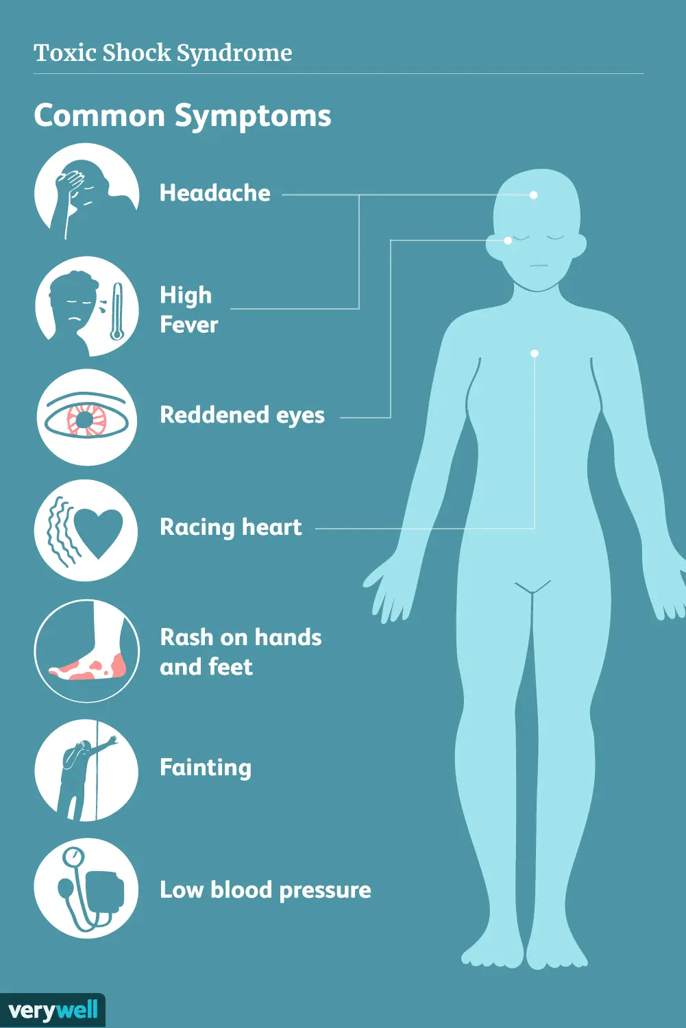 Toxic shock syndrome (TSS) &#8211; symptoms, treatment