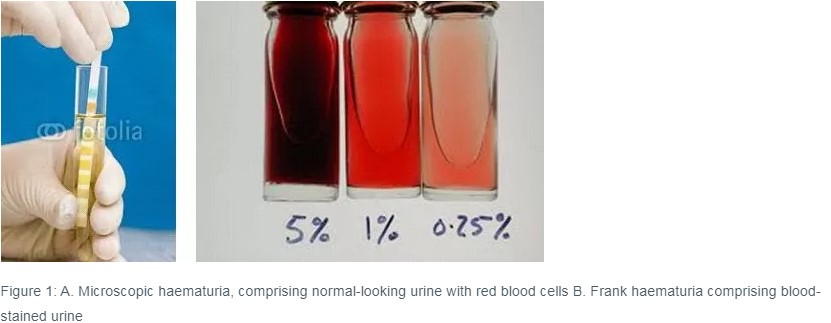 Traces of blood in the urine