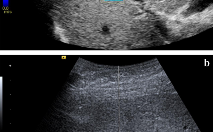 Transient ultrasound &#8211; characteristics, indications and the course of the examination