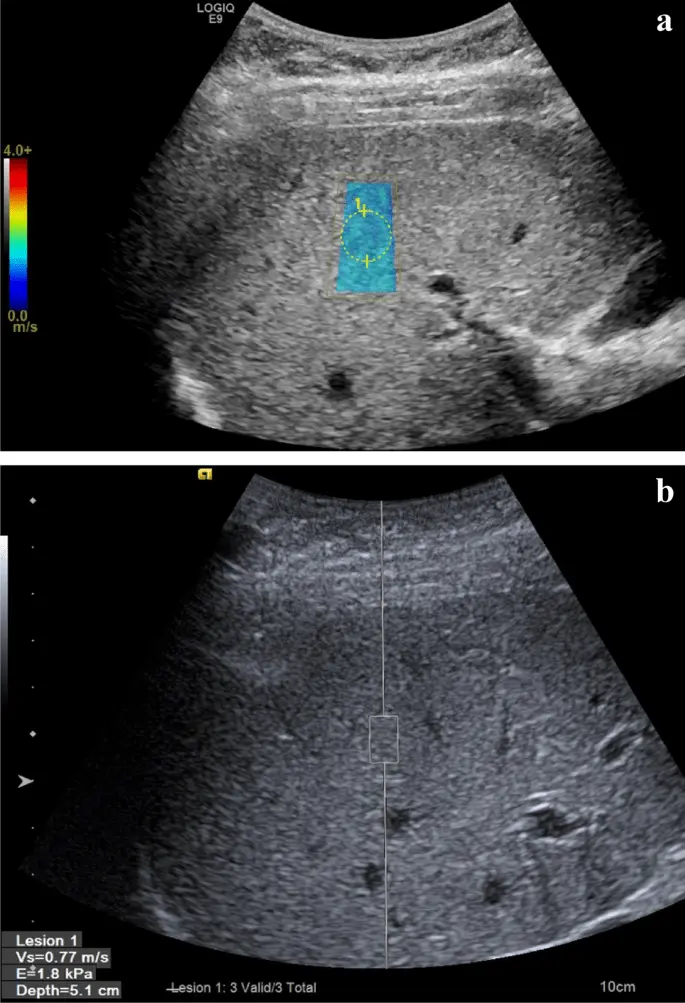 Transient ultrasound &#8211; characteristics, indications and the course of the examination