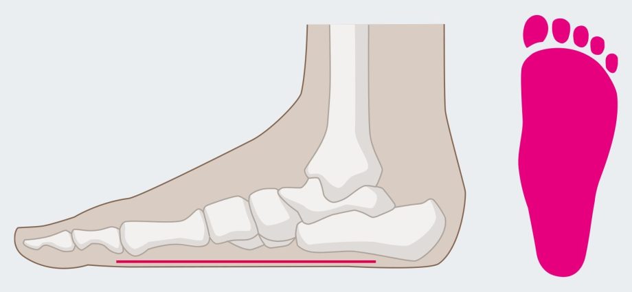 Transverse flat feet &#8211; causes and symptoms. What is the treatment of transverse flatfoot?