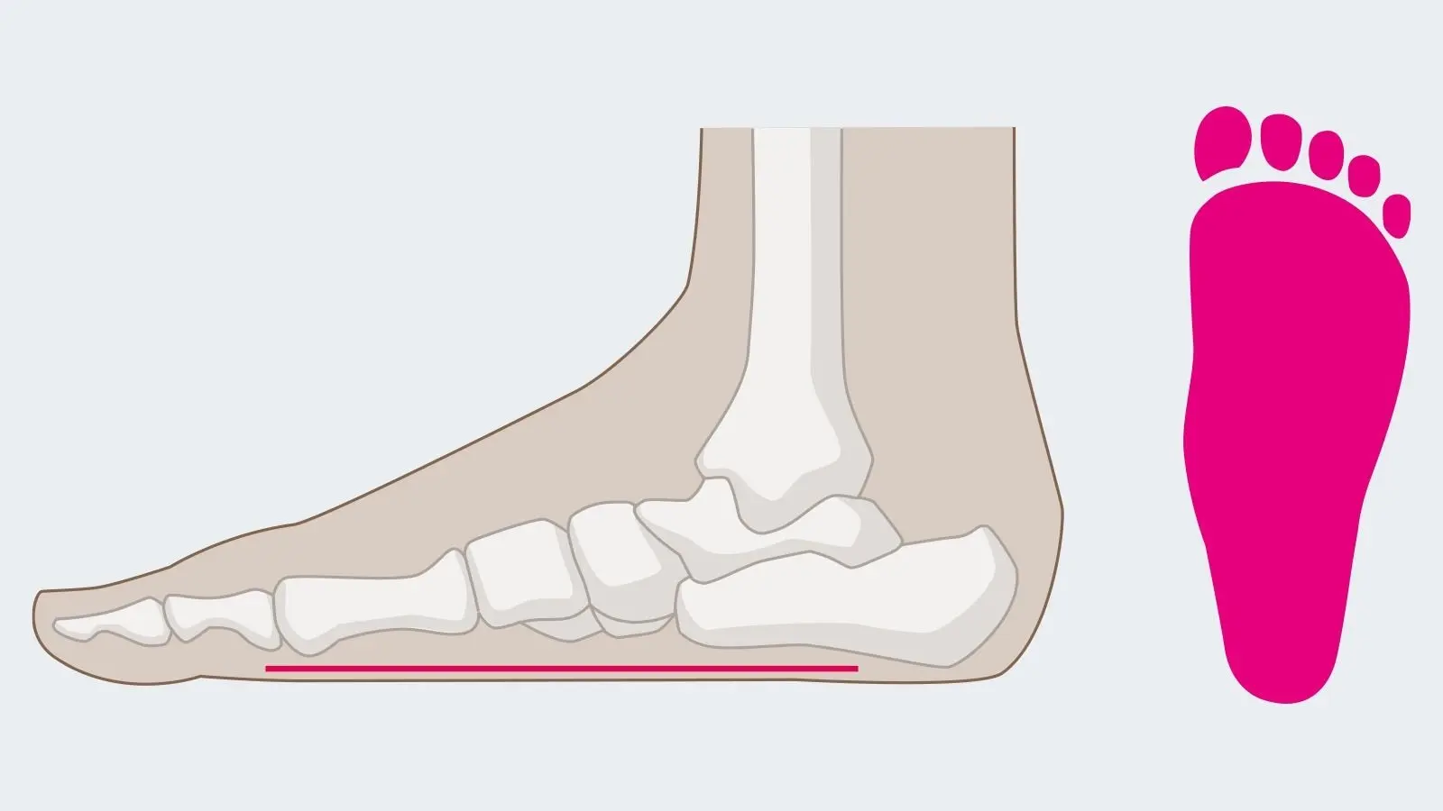 Transverse flat feet &#8211; causes and symptoms. What is the treatment of transverse flatfoot?