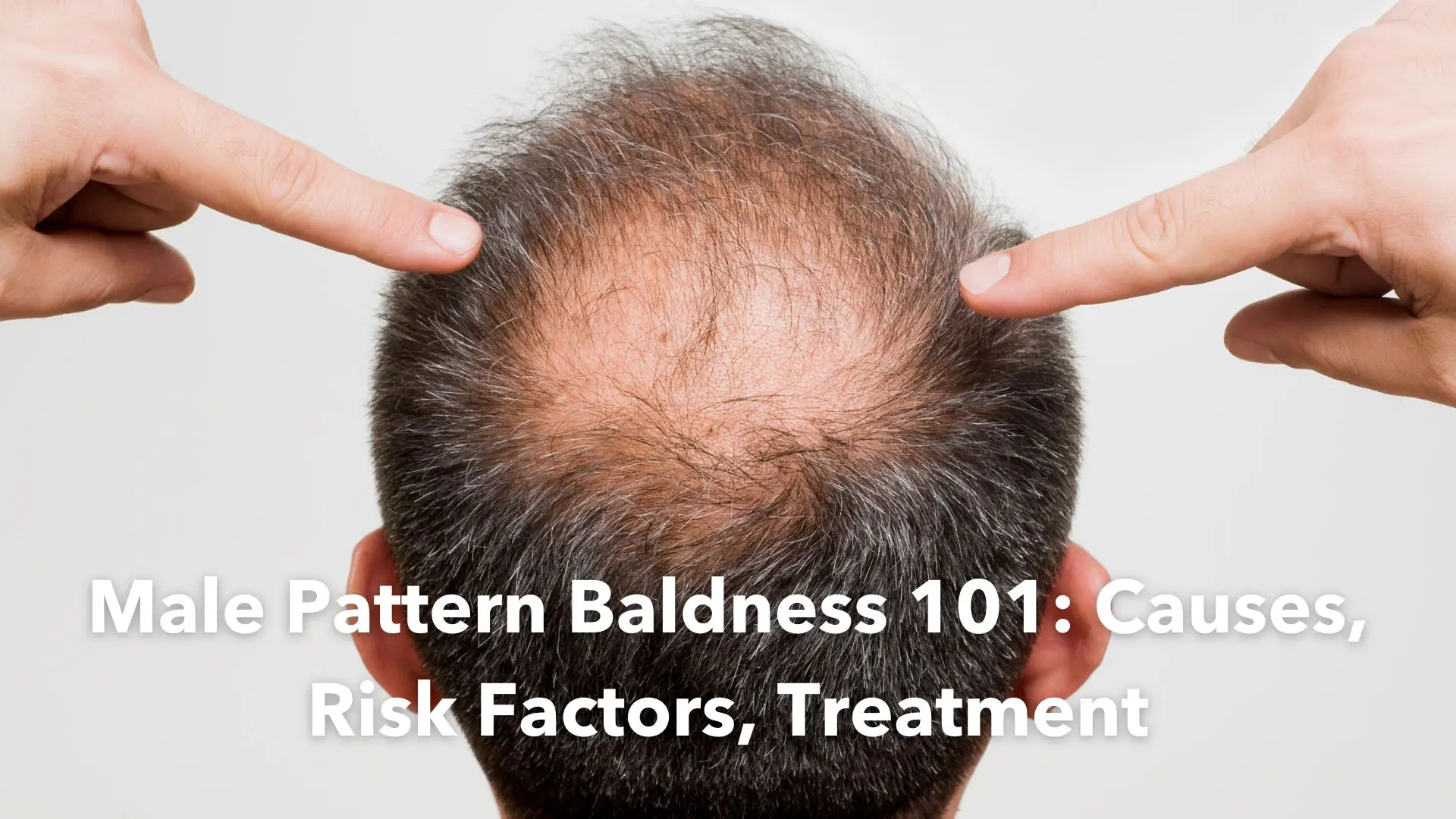 Treatment of baldness can cause a permanent decrease in libido