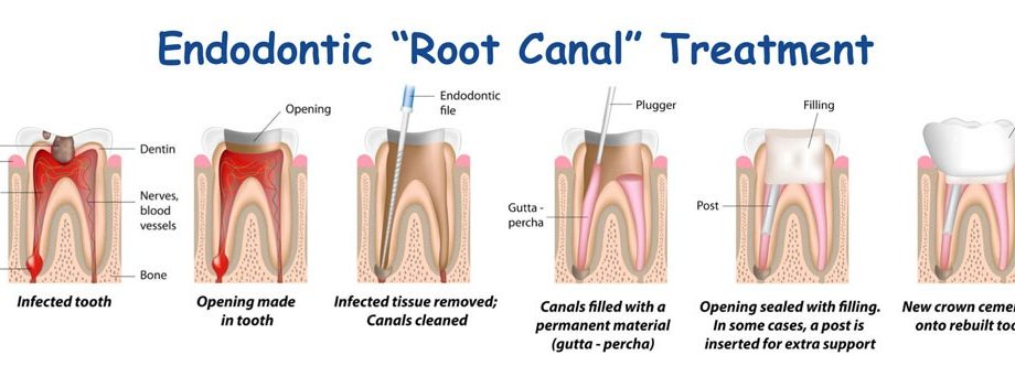 Treatment of caries and filling cavities in deciduous teeth