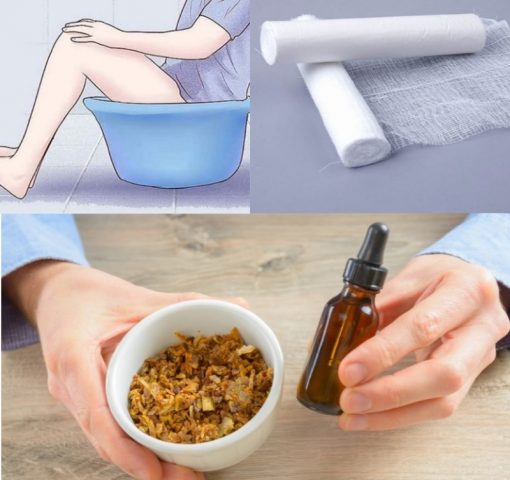 Treatment of hemorrhoids with propolis