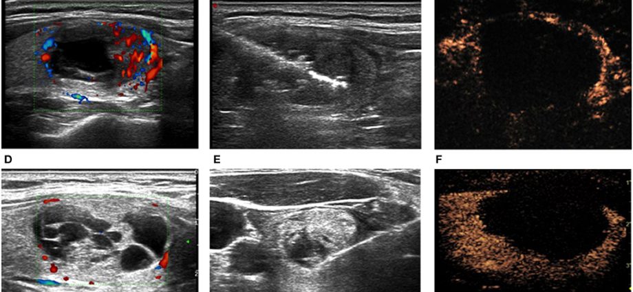 Treatment of thyroid nodules with the innovative Echolaser