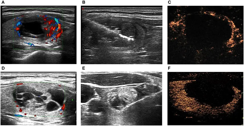 Treatment of thyroid nodules with the innovative Echolaser