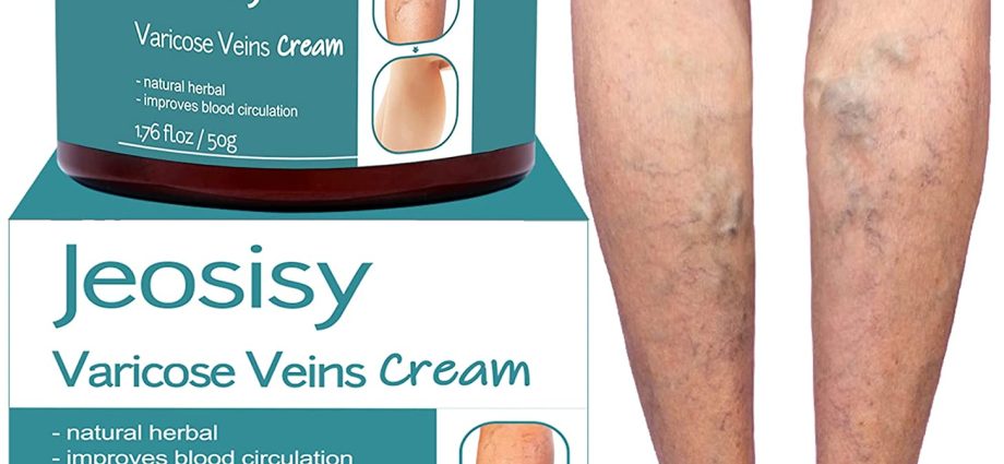 Treatment of varicose veins &#8211; the latest anti-varicose technologies