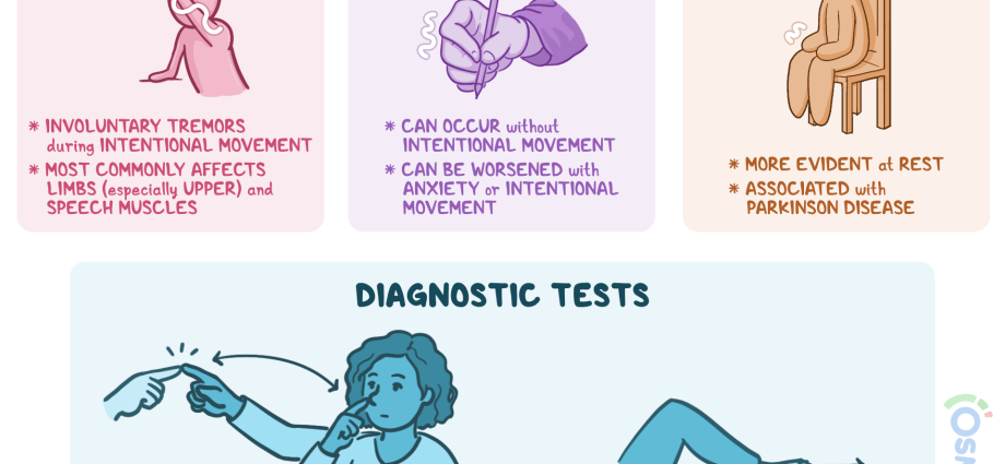 Tremor (hands) &#8211; causes, types of hand tremors, treatment