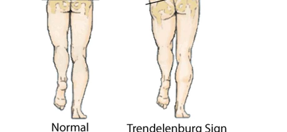 Trendelenburg symptom &#8211; causes, symptoms, treatment