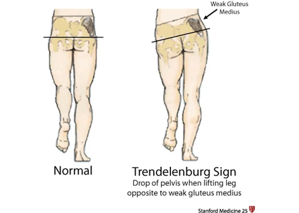 Trendelenburg symptom &#8211; causes, symptoms, treatment