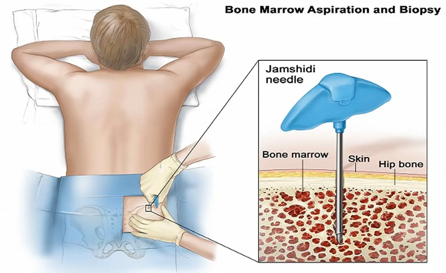 Trepanobiopsy &#8211; what is it? Possible complications after trepanobiopsy surgery