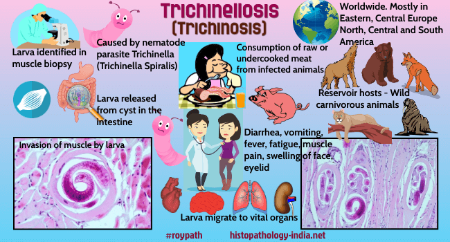 Trichinellosis Symptoms Treatment And Causes Of The Disease Healthy Food Near Me