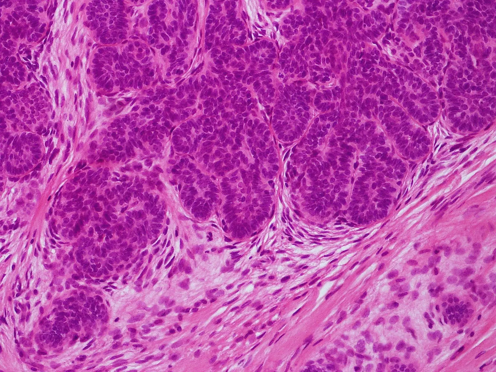 Trichoblastoma