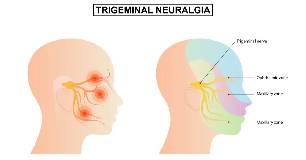 Trigeminal neuralgia &#8211; a disease that destroys life