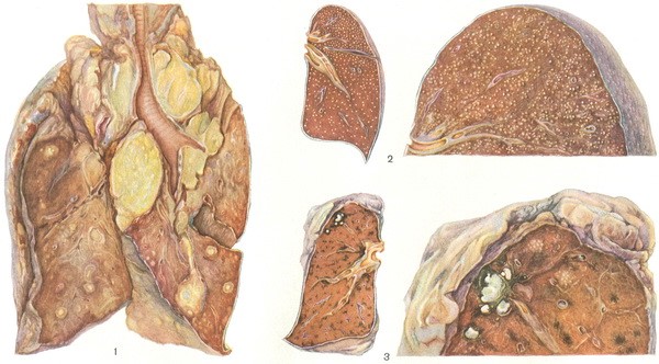 Tuberculosis in cattle: prevention, diagnosis and treatment